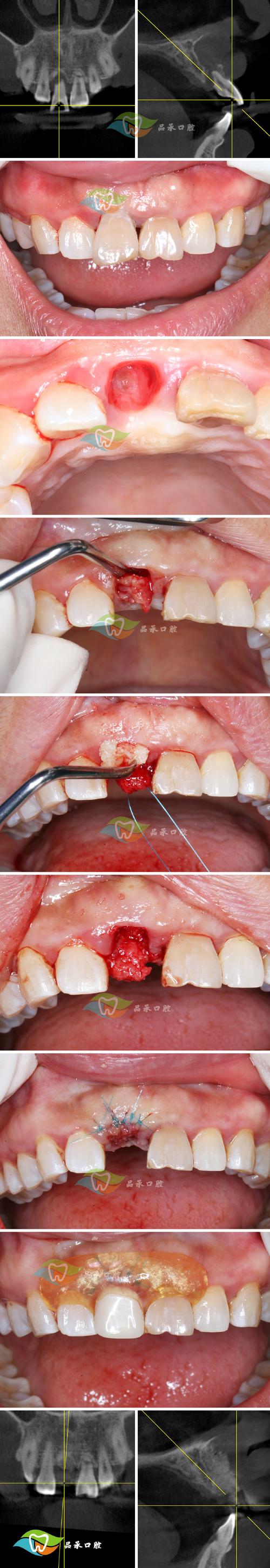蓉城官方:韦林顿上唇部贯通伤,牙半脱位,上颌前牙区牙槽骨骨折