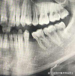 韦林顿确诊上唇部贯通伤；11、21牙半脱位；上颌前牙区牙槽骨骨折