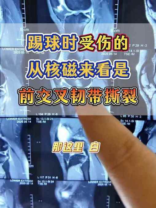 皇马官方：罗德里戈手术成功，修复了前交叉韧带和外侧半月板断裂