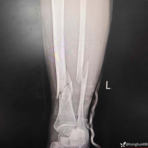 早日康复！官方：美因茨前锋西拉斯左胫骨和腓骨骨折