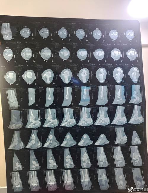 意天空：K·图拉姆因右脚踝受伤被换下，将接受进一步详细检查
