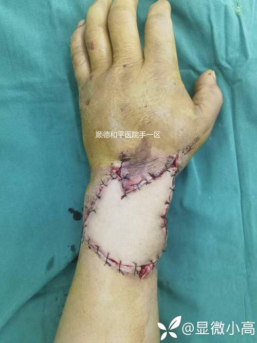 记者：奥斯梅恩手臂有粉碎性骨折的情况，预计将接受手术