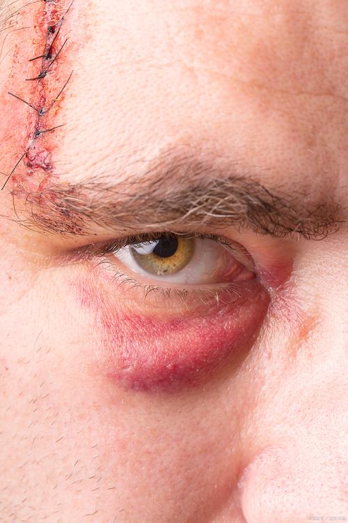 记者谈魏震伤情：眼部受伤有点影响视线，回到上海后得继续治疗