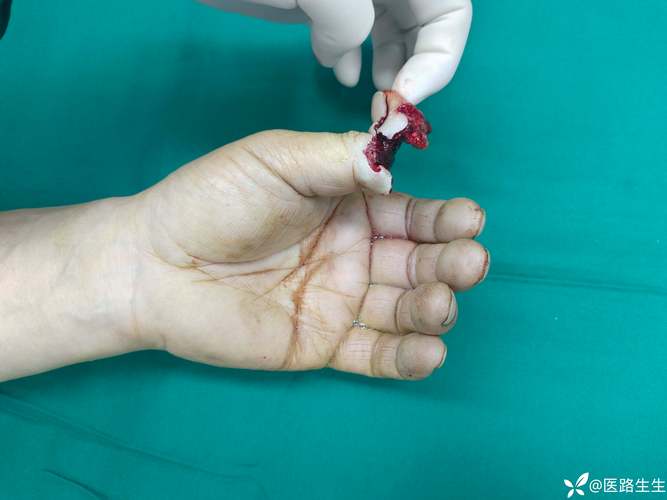 手指被割成重伤！诺阿·朗：我的大拇指还连在手上，医生说能保住