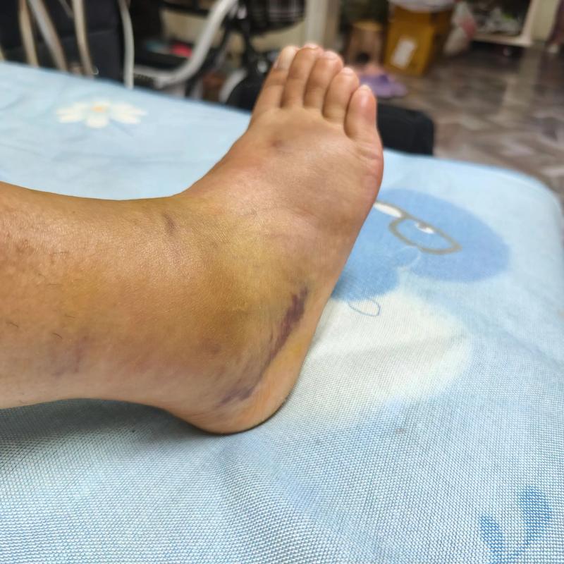 这能认错？记者吐槽姆总遭误诊：我骨折时医生在腿上画了巨大箭头