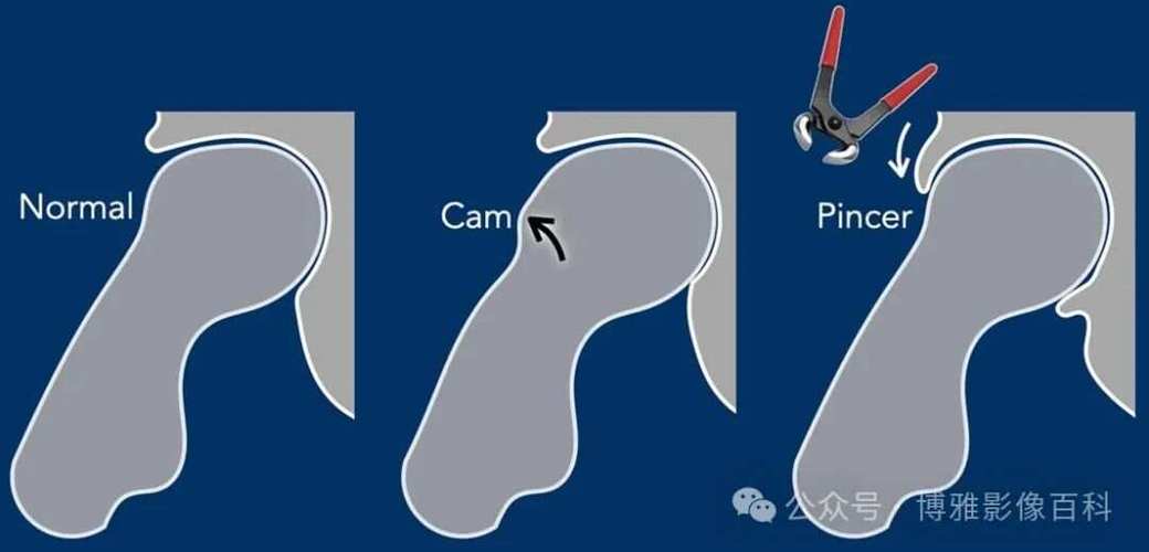 掘金记者：纳吉赛后拄拐离开球馆 伤情为左髋关节撞击综合征