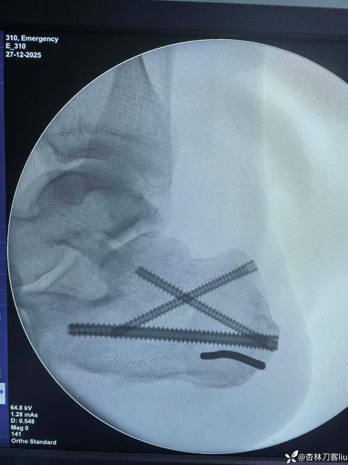 里昂官方：福法纳接受脚踝手术，取出去年10月植入的固定器械