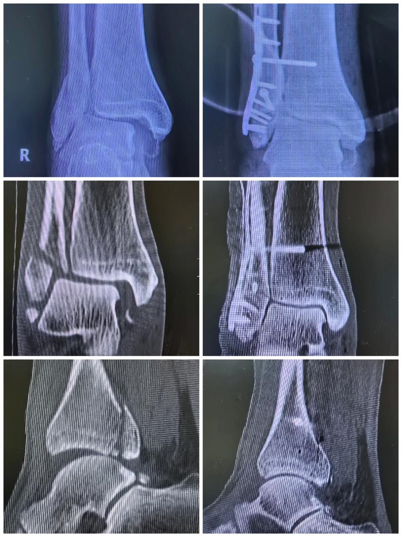 Scotto：兰代尔遭遇右脚高位踝关节扭伤 两周后重新接受评估