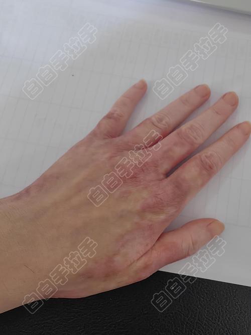 早日康复!帕尼切利社媒晒术后照片报平安