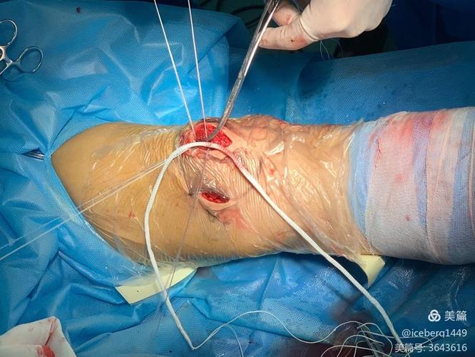 远藤航:植入人工韧带大约需要3个月康复 希望赶在5月底前复出