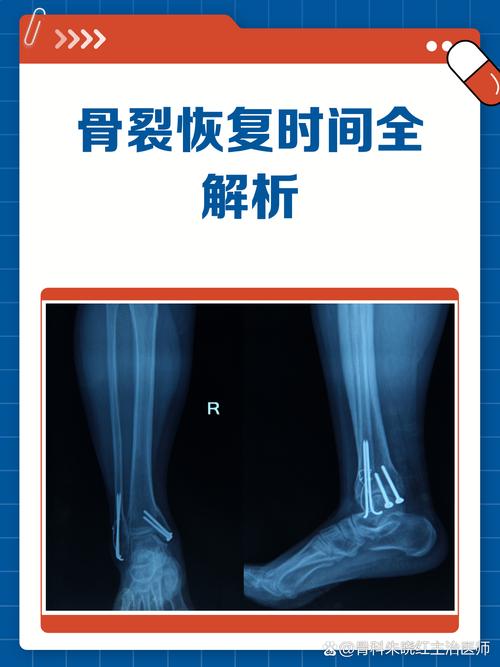 阿斯:法比安左膝髌骨骨裂已缺阵3个月,他的复出还需等待