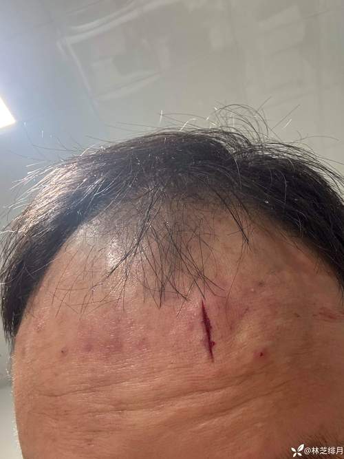 给姆总整破相了！姆巴佩晒脸部受伤近距离特写，眉骨缝了3针