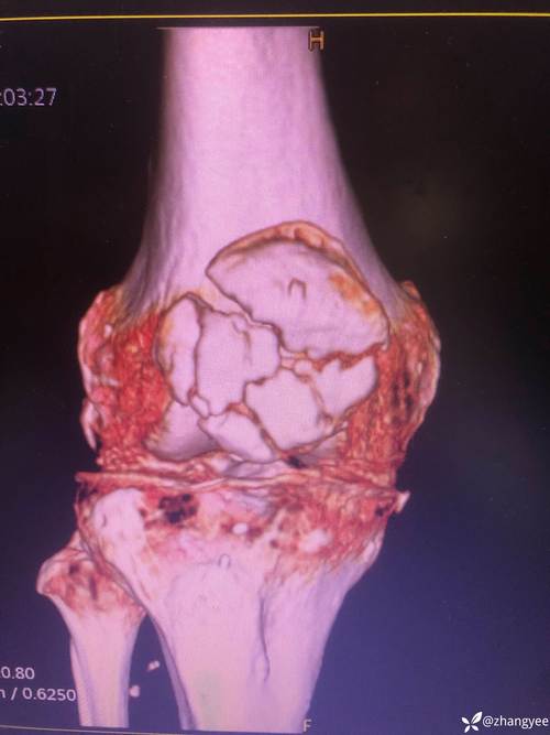 重伤!海港官方:加布里埃尔右膝髌骨肌腱断裂,将尽快进行手术