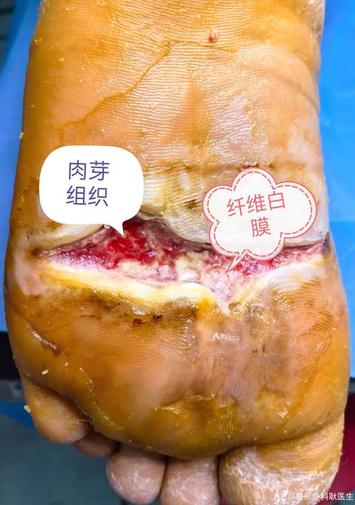 法媒:埃基蒂克跟腱确实受伤了,目前尚不清楚伤势严重程度